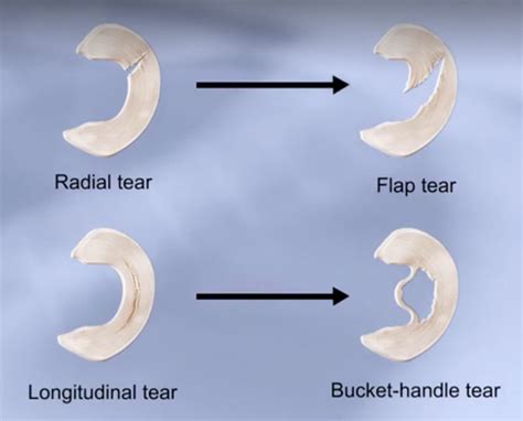 Meniscal Tear Types