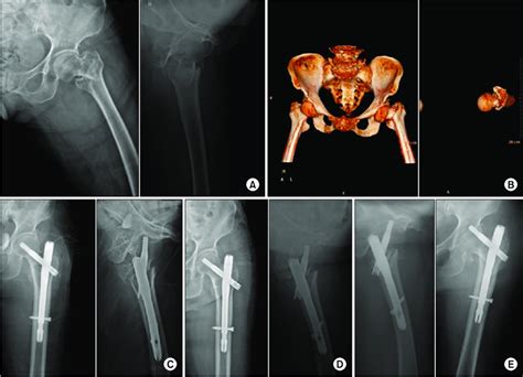 (A) An 88-year-old woman showed basicervical type of fracture with ...