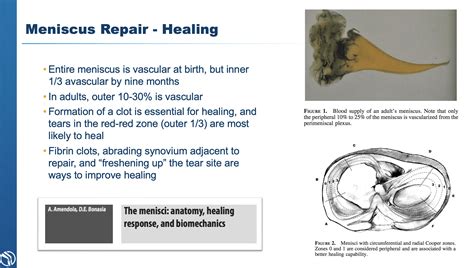 3 Types of Meniscus Tear Treatment | Knee Specialist | Baton Rouge, LA