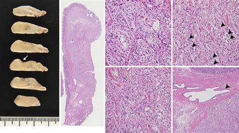 Figure5.The histology of the resected duodenal tumor. A macroscopic... | Download Scientific Diagram