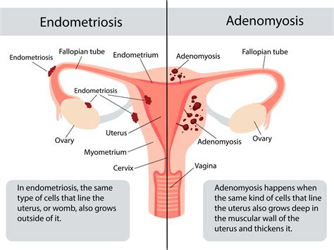 Endometriosis & Adenomyosis: Symptoms, Diagnosis, Treatment | Pantai ...