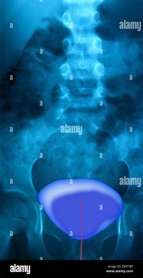 Retrograde cystography Stock Photo - Alamy