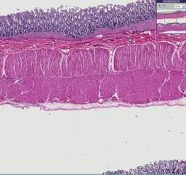 Histopathology Colon--Hirschsprung disease - YouTube