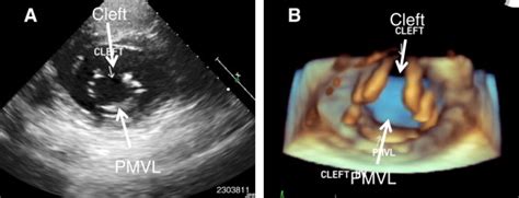 Native Mitral Regurgitation : 네이버 블로그