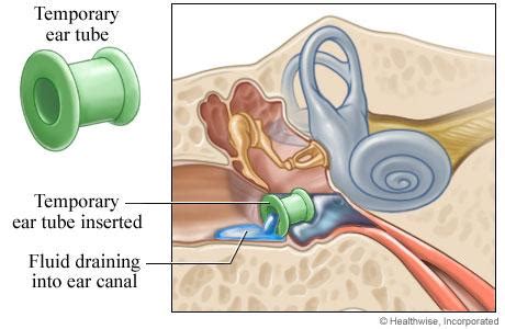 eartubes ear tubes diagram - Speech is Beautiful