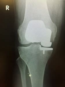 Unicondylar Knee Joint Replacement | Buckinghamshire knee surgery