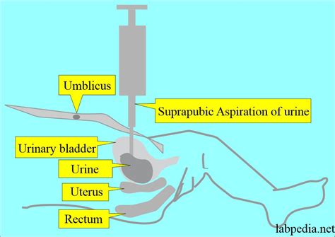 Suprapubic Aspiration