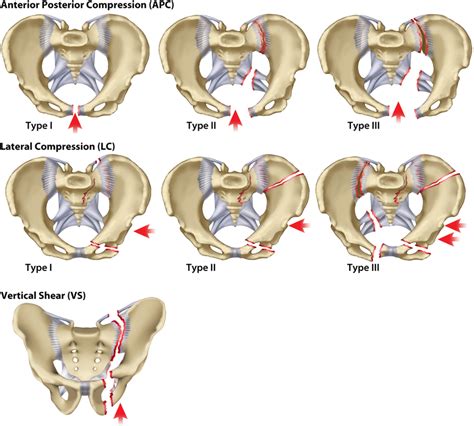 Pelvic Fractures - Physiopedia