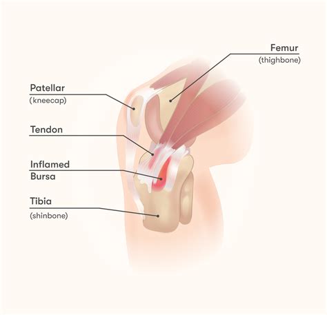 Pes anserine bursitis - volthoughts