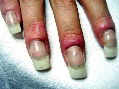 EMA Vs MMA Acrylics : Get educated about MMA and its harmful effects on your nails.