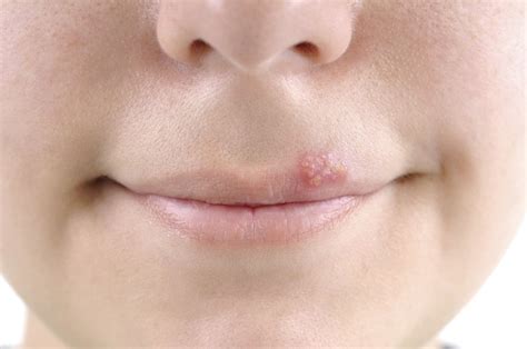 Preventing cold sores - Harvard Health