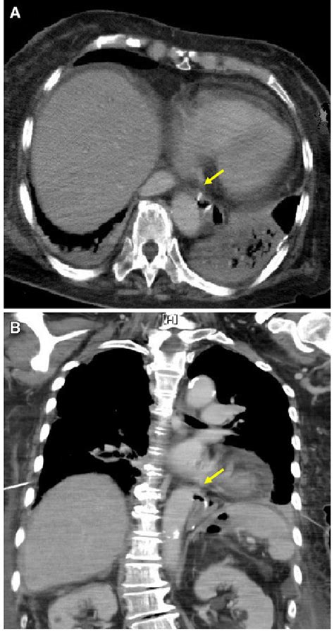 Contrast-enhanced computed tomography taken 4 days after the first... | Download Scientific Diagram