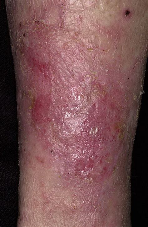 Stasis Dermatitis on Legs Pictures – 174 Photos & Images / illnessee.com