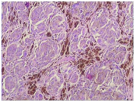 Histopathological examination demonstrated numerous melanin granules... | Download Scientific ...