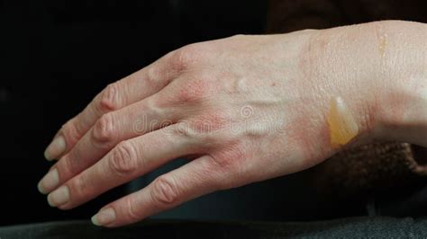 Close-up of a Woman S Hand with a Blister from a Boiled Water Burn, Damaged Skin, 1st or Second ...