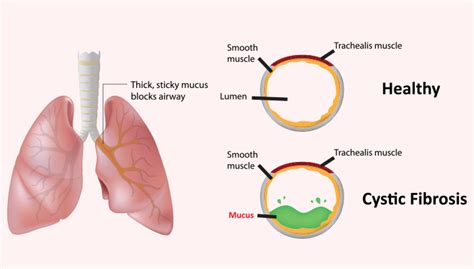 Cystic Fibrosis: Symptom, Causes, Diagnosis & Treatment » How To Relief