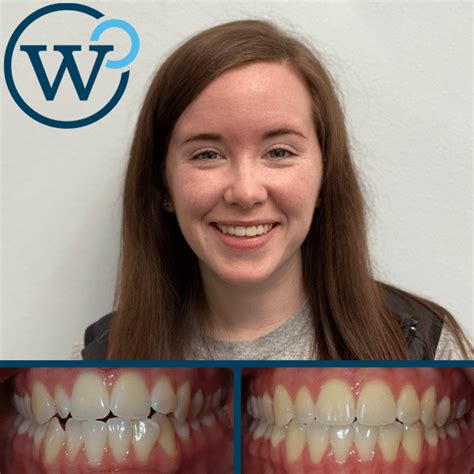 Invisalign Vs Braces Results