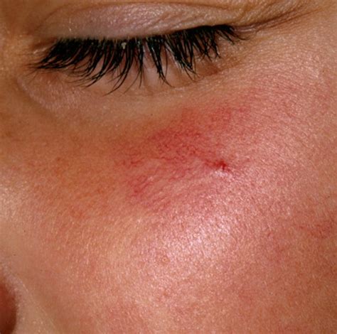 👉 Spider Angioma - Symptoms, Causes, Pictures, Treatment (November 2021)