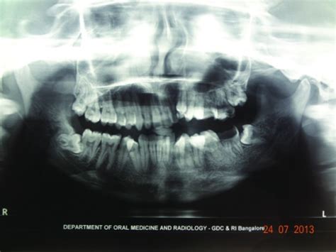 Morphea (Localized Scleroderma) — Symptoms and Prognosis | Lecturio