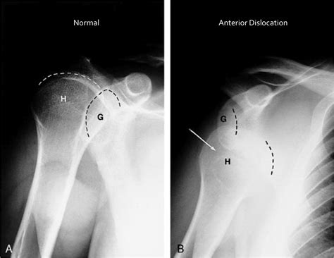 Physio Questions: Shoulder Complex (Part III) - Anterior/Posterior/Multidirectional Dislocations ...