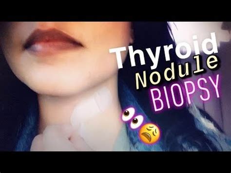 THYROID NODULE BIOPSY! - YouTube