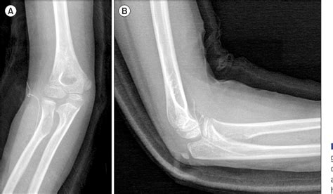 Radial Tuberosity - The radial tuberosity is located just distal to the ...