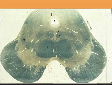 brainstem midbrain inferior colliculus Diagram | Quizlet