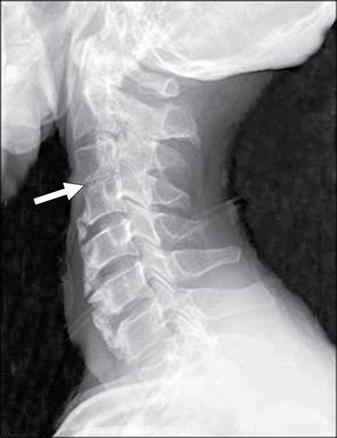 A Complete C3-C4 Spinal Dislocation | Critical Care Medicine | JAMA ...