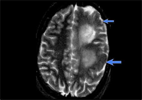 The Radiology Assistant : Brain - Epilepsy: Role of MRI