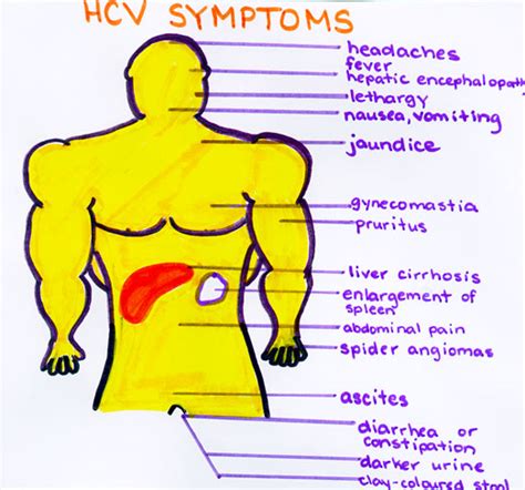 Hepatitis C Symptoms: The lethal 'C'