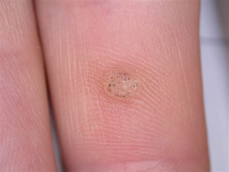 Viral warts - Dr Jonathan Bowling