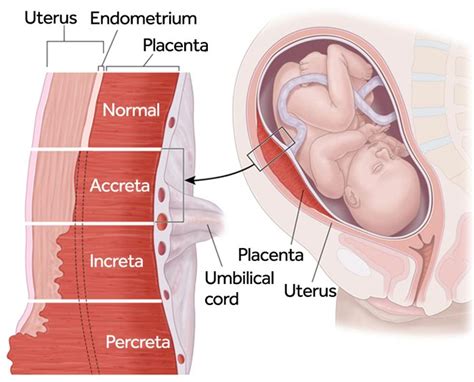 Placenta Previa | Birth Injury Law Firm