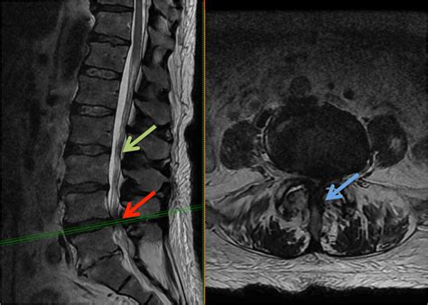 Lumbar laminectomy - Lubbock, Amarillo, Midland | Sergiy Nesterenko, M.D