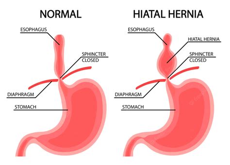 Hiatal Hernia Symptoms, Complications and Treatment - Dr Datta Ram