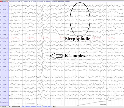 K complex - EEGpedia