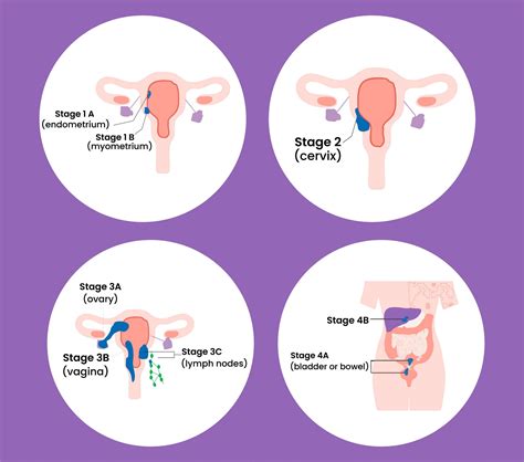 What is Endometrial Cancer? It's Symptoms, Stages etc