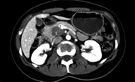 Uncinate Process Of Pancreas Anatomy