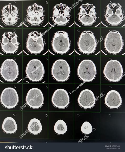 Ct Scan Images Ct Brain Without Stock Photo 1856076508 | Shutterstock