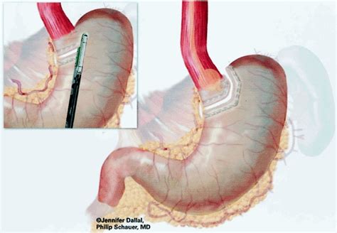 Creation of gastric pouch. | Download Scientific Diagram