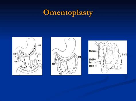 Sternal Dehiscence 10.5