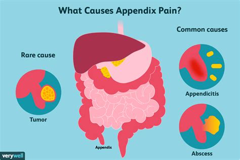 Appendicitis Pain Location