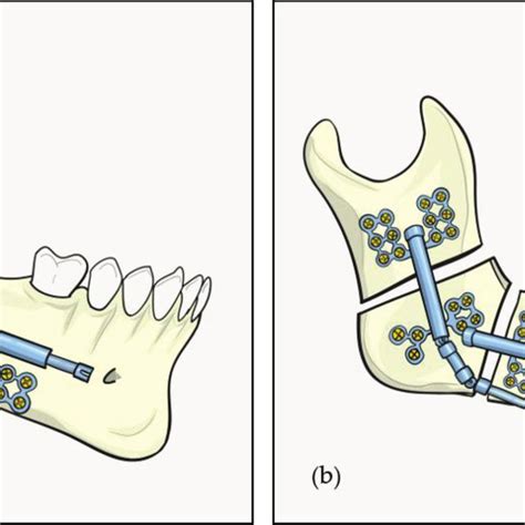 The phases of distraction osteogenesis. (a) Latency period in which... | Download Scientific Diagram