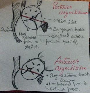 ASYNCLITISM Phases Of Labor, Sutures, Fetal, Postpartum, Severe, Pregnancy, Presentation ...