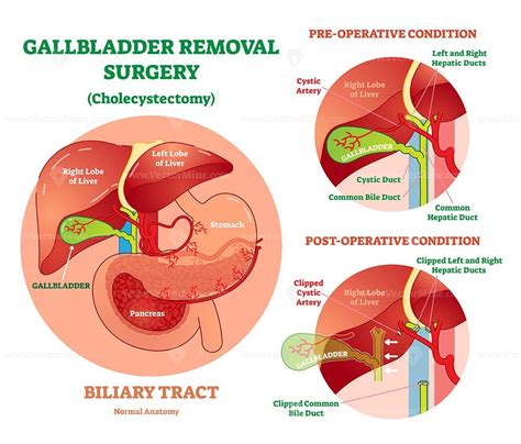 Cholecystectomy - Gallbladder removal surgery, anatomical vector ...