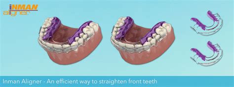 inman-aligner | Manchester Dental Practice