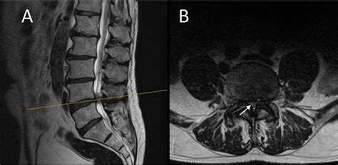 Lumbar spinal stenosis | The BMJ