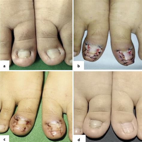 a Ingrowing toenail of digiti I pedis sinistra with medial periungual... | Download Scientific ...