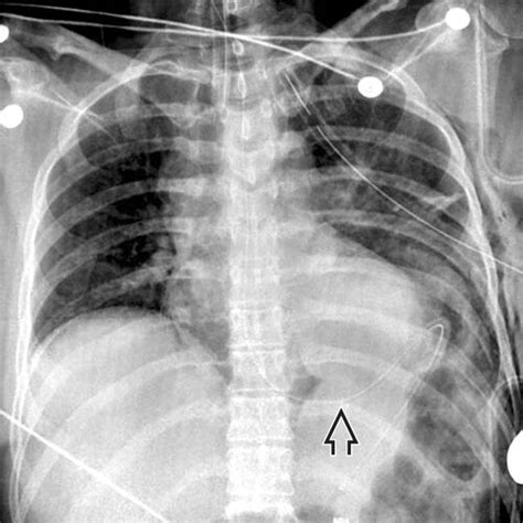 Traumatic Diaphragmatic Rupture | Radiology Key