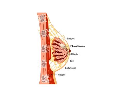 Breast Fibroadenoma Management: Treatment Without Surgery - IceCure