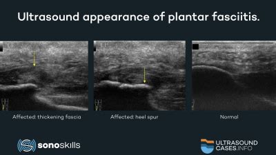 Comparing ultrasound with MRI and CT in measuring the plantar fascia / SonoSkills